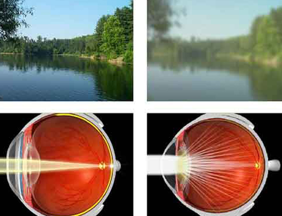 Cataract